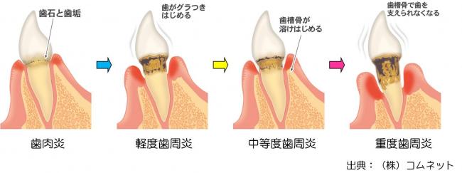 歯肉炎から「歯周炎」へ